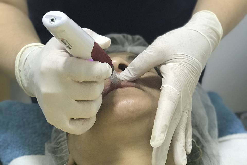 Microneedling